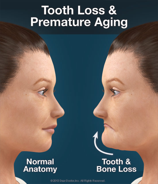 How tooth and bone loss can change facial support and appearance over time